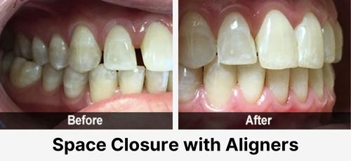 A real before-and-after case of space closure with clear aligners at Acadia Family Dentistry