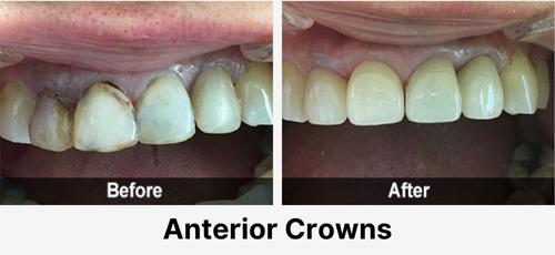 Real before and after dental case at Acadia Family Dentistry: front-tooth crowns
