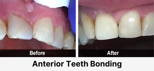 Real before and after dental case at Acadia Family Dentistry: tooth bonding