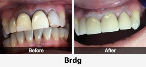 Real before and after dental case at Acadia Family Dentistry: dental bridge
