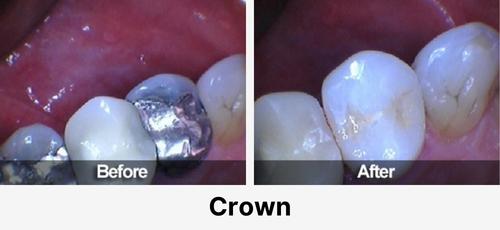 Real before and after dental case at Acadia Family Dentistry: crown