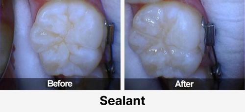 Real before and after dental case at Acadia Family Dentistry: sealant