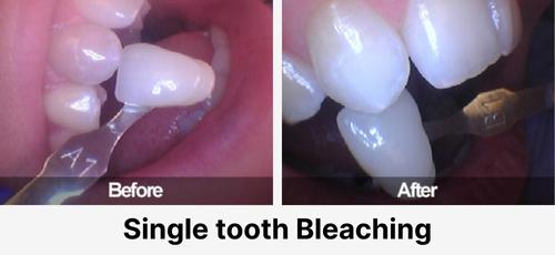Real before and after dental case at Acadia Family Dentistry: whitening