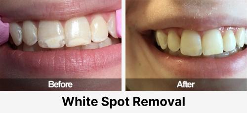 Real before and after dental case at Acadia Family Dentistry: white-spot removal